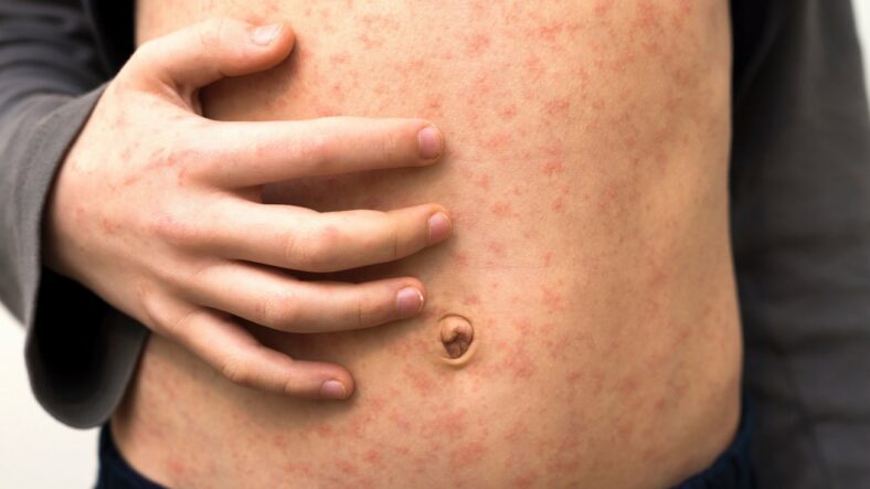 csm_Masern__2__0bcc0b1d45